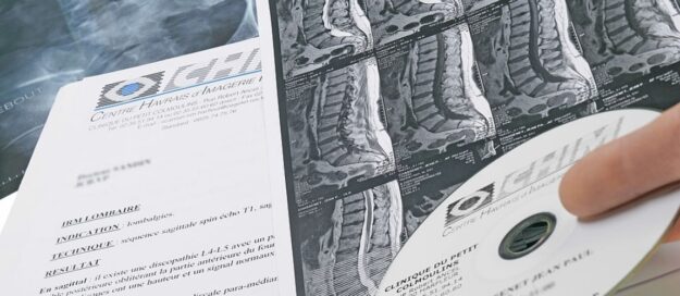 Hernia discal (1)